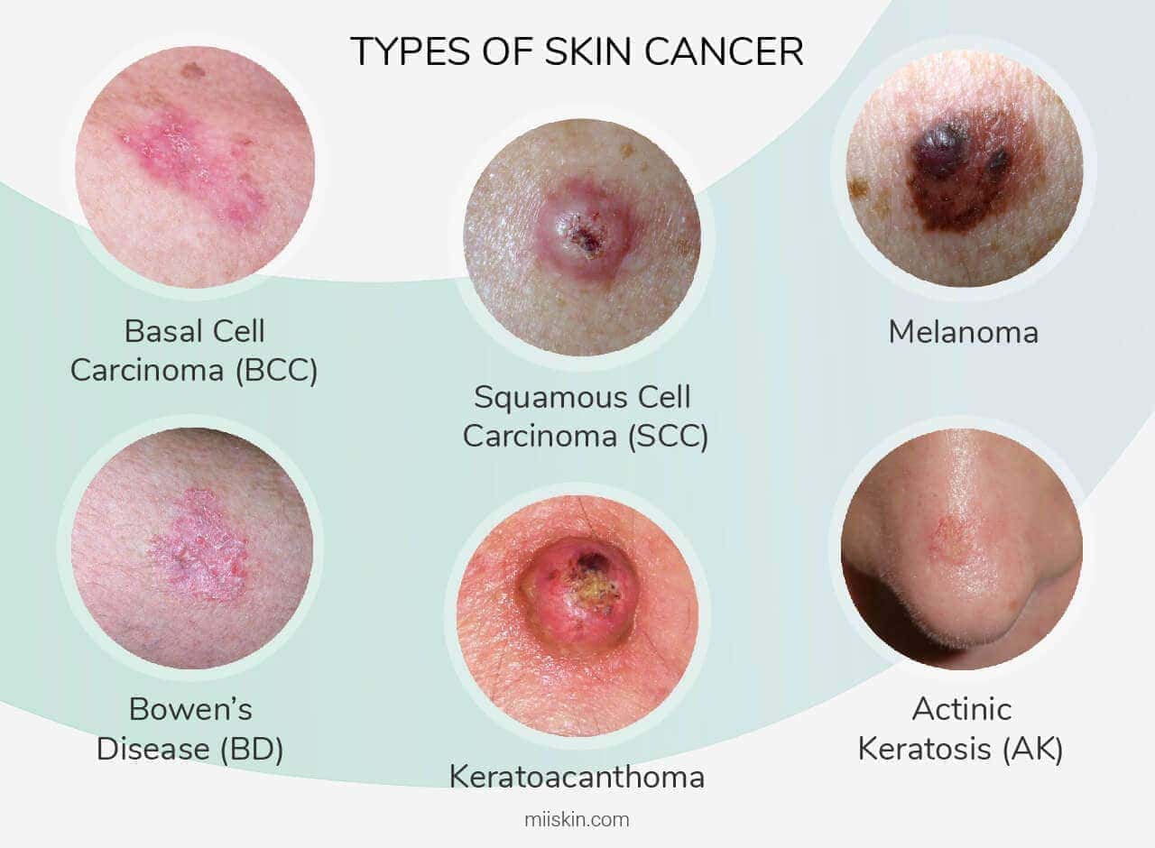 types-of-skin-cancer.jpg