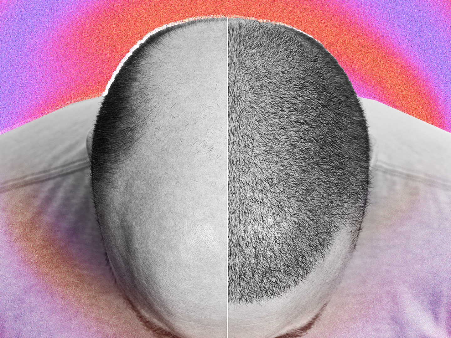 hair-transplant-header.jpg