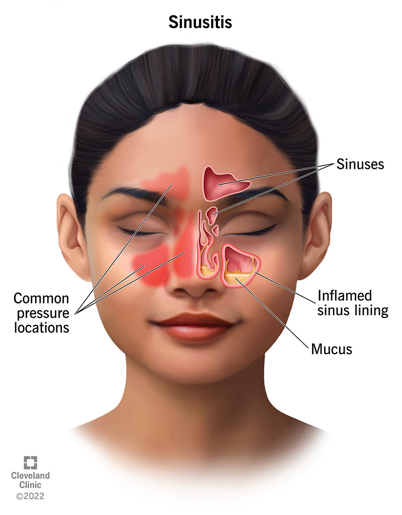 17701-sinusitis