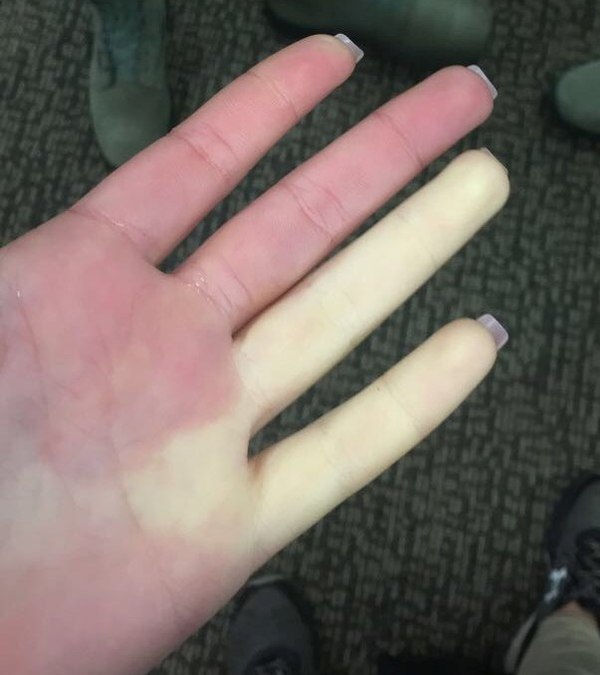 600px-Raynaud_syndrome_on_female_airman%27s_hand.jpg