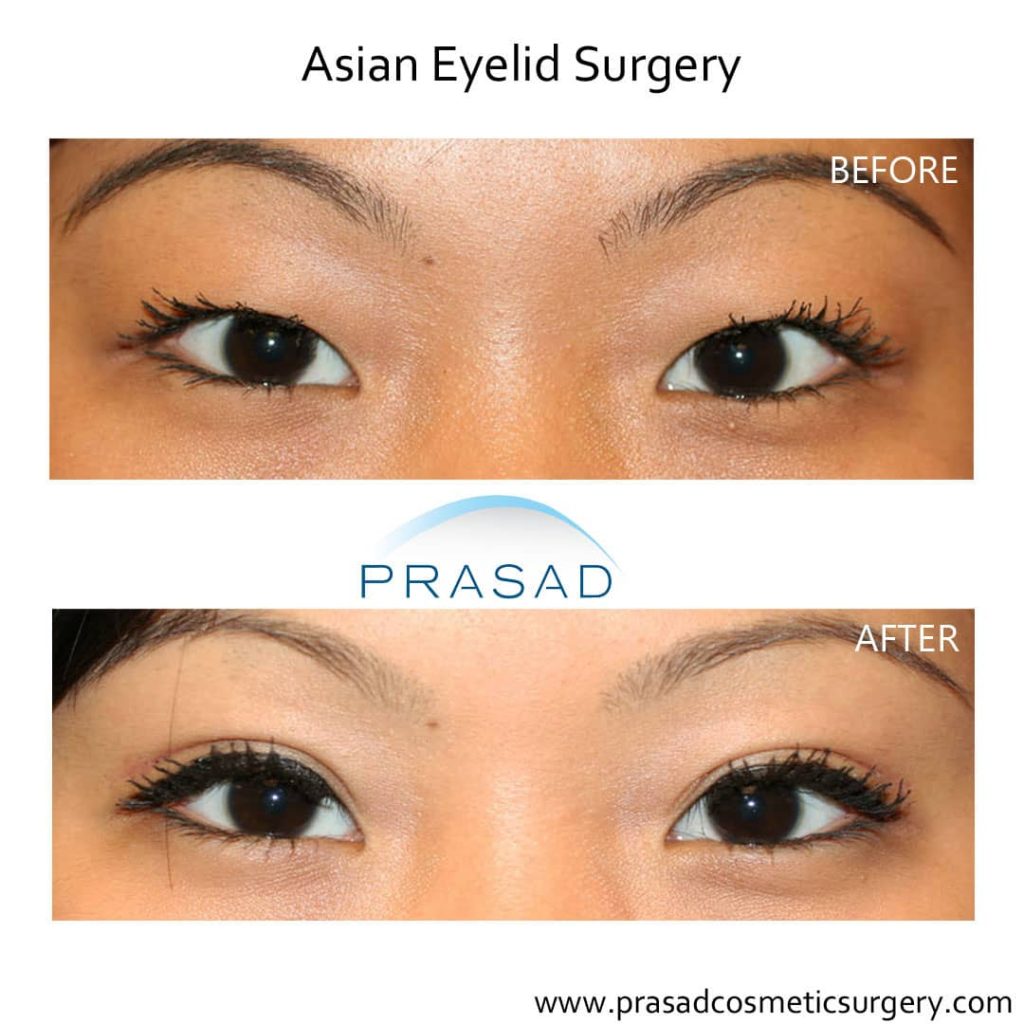 Asian-Double-Eyelid-Surgery-Before-and-After-Incisional-Fem-1024x1024.jpg