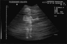 ultrasound.gif