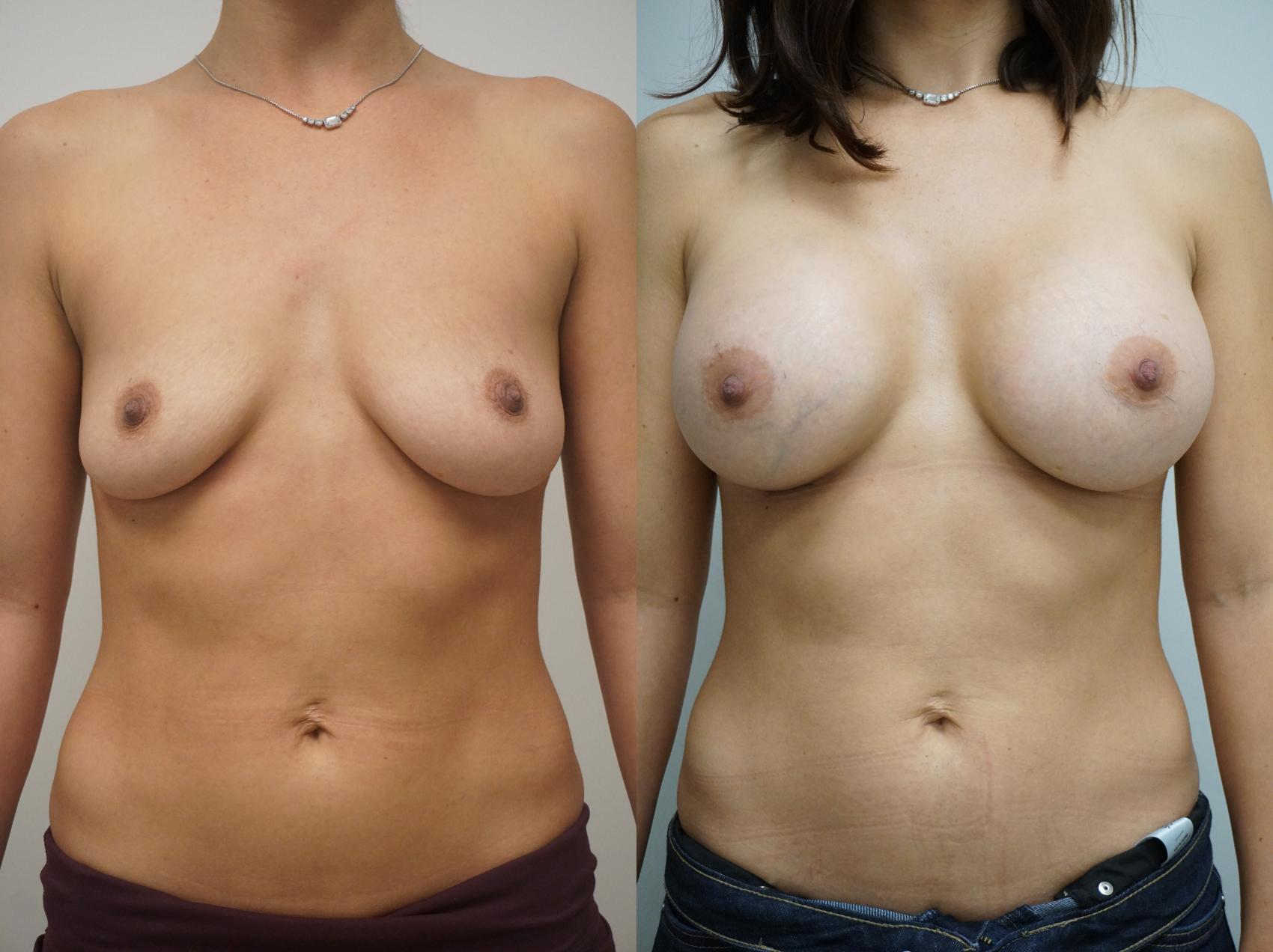 breast-augmentation-255-view-1-detail.jpg